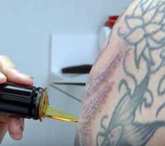 a tattoo being removed by laser